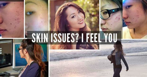 My Acne Story, PLUS How to Banish Acne Scars & Regain Your Confidence This Fall